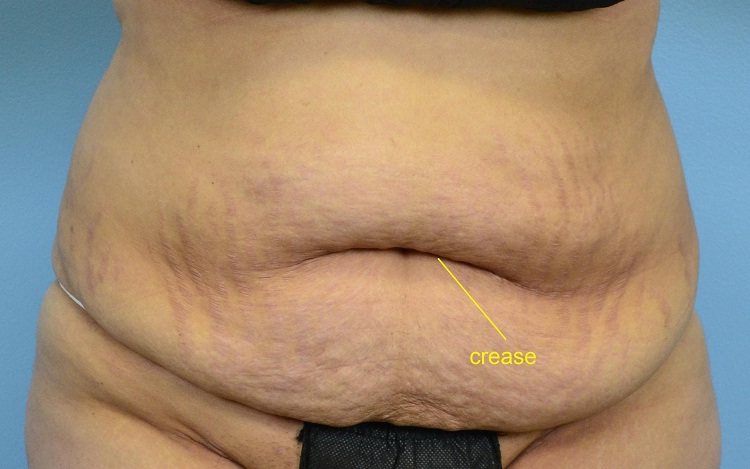 Belly Crease-24 Signs That You Are Fat