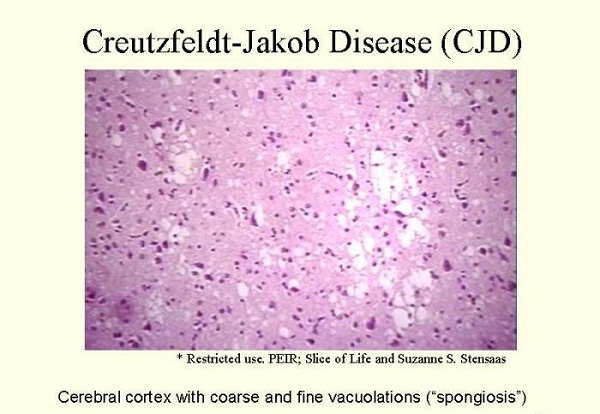 CJD-Incurable Diseases