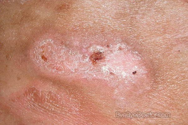 Ulcers that do not clear up-Signs That You Have Cancer
