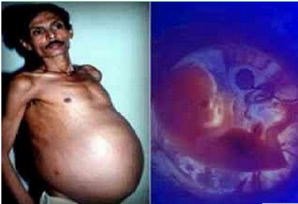 Baby Brother-Most Shocking Things Found In Peoples Stomachs