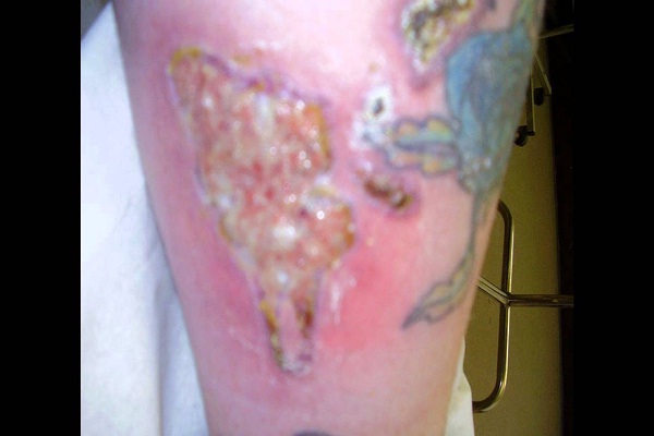 Infected-Tattoo Removal Disasters
