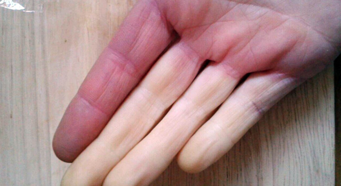 15 Things Only People With Raynaud's Will Understand