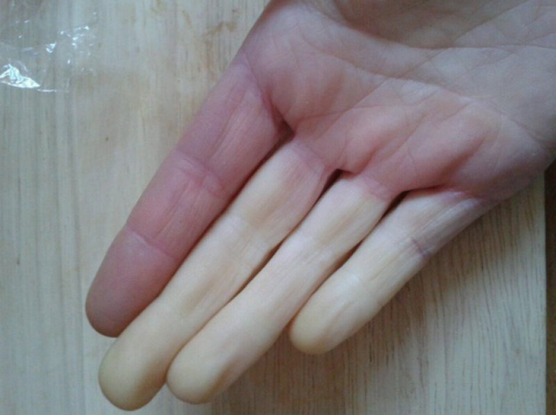 You Have to Deal with This More Often-15 Things Only People With Raynaud's Will Understand