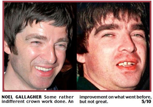 Noel's New Teeth-Celebrities Who Have Fixed Their Teeth