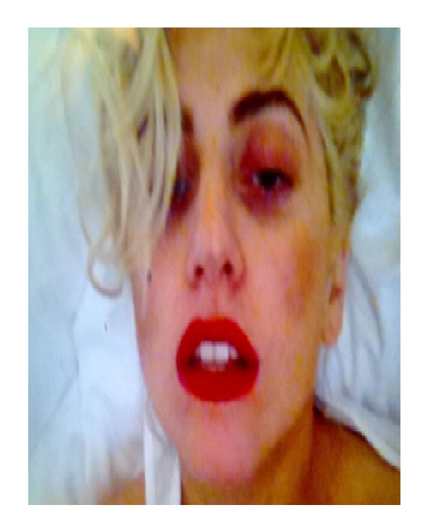 Lady Gaga-Bizarre Celeb Injuries