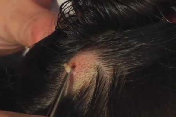 Botfly In My Head -12 Most Disgusting Videos Ever Made