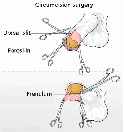Circumcision-Bizarre Banned Names