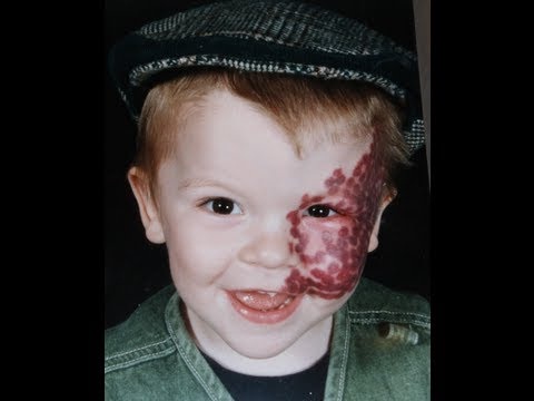Facial birthmarks-Bizarre Birthmarks Ever