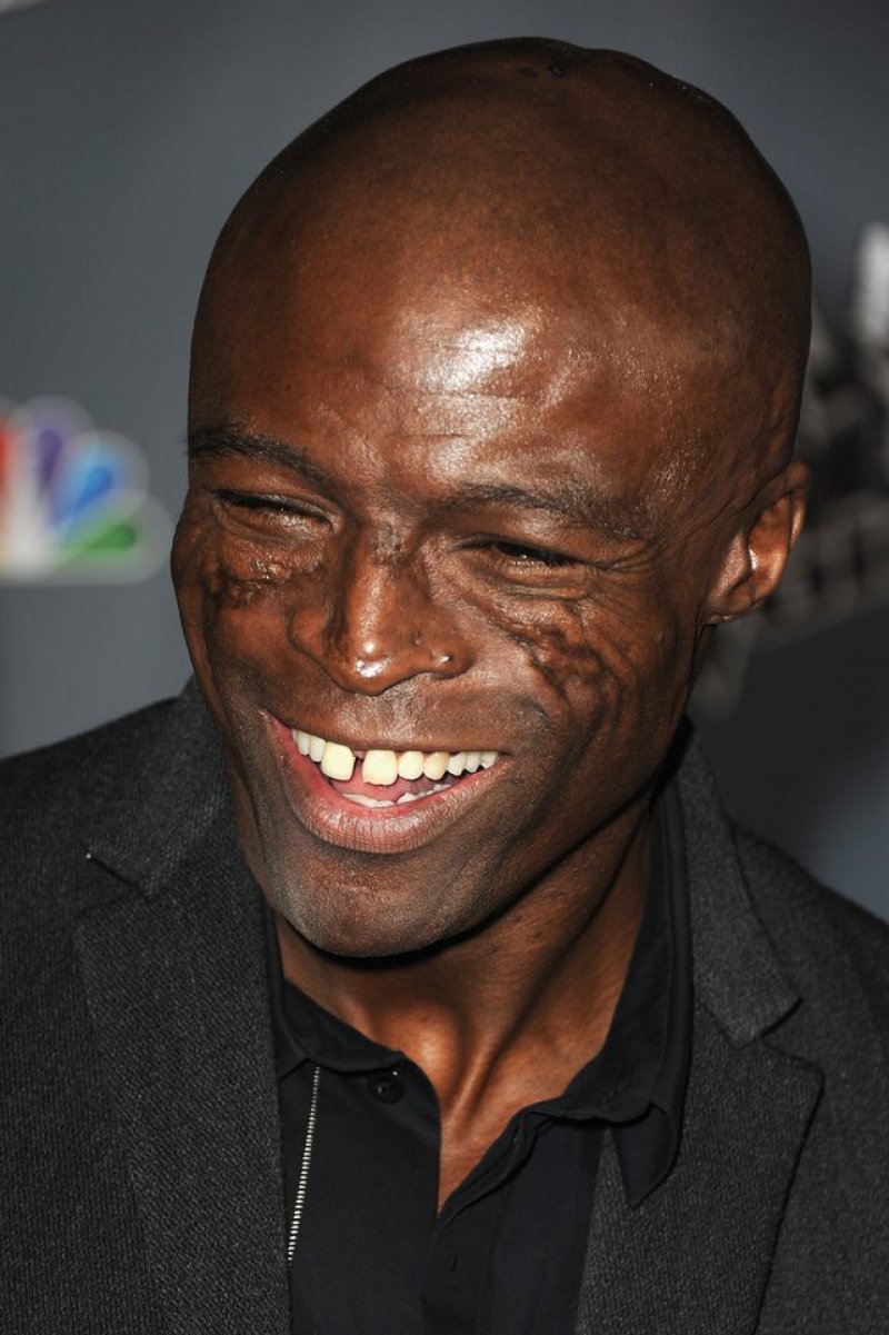 Seal - Cheeks & Face-12 Celebrities With Scars And Deformities