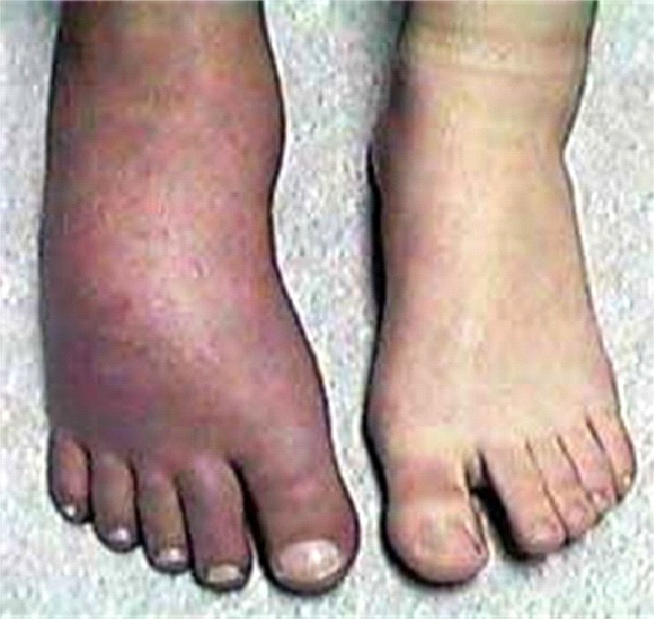 Causalgia-Most Painful Diseases In The World