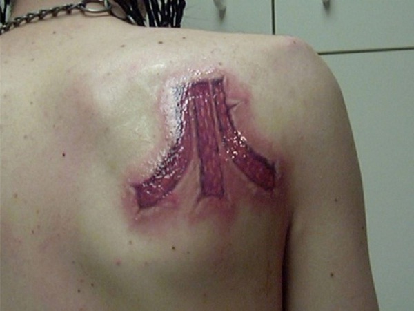 Looking sore-Tattoo Removal Disasters