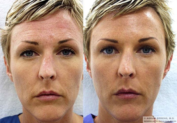 Botox Can Be Learnt In A Weekend.-Things To Know About Plastic Surgery