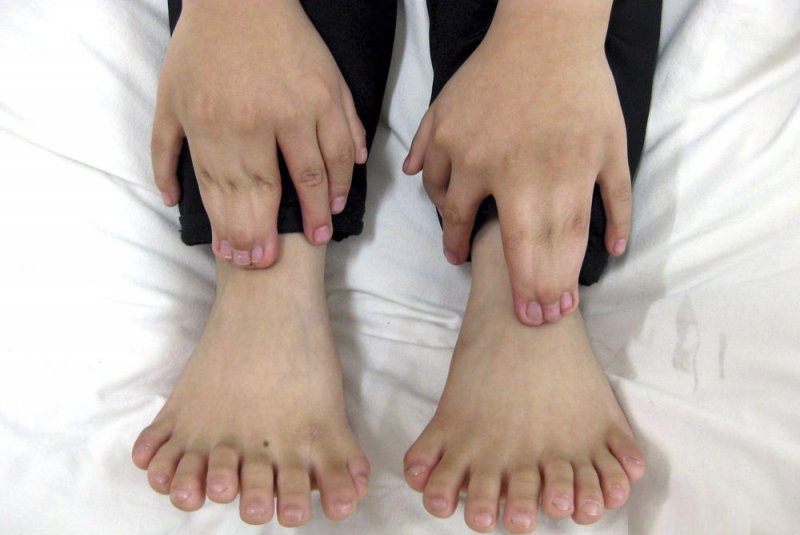 Toes Galore-People Who Were Born With Extra Body Parts