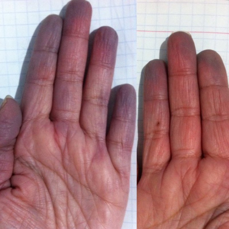 When Your Blood Rushes Back in...-15 Things Only People With Raynaud's Will Understand