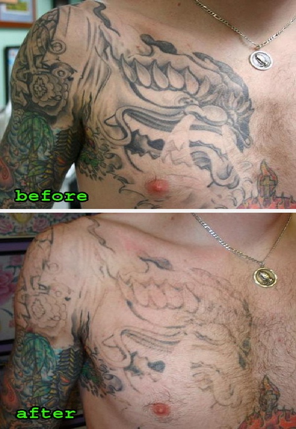Poor Attempt-Tattoo Removal Disasters