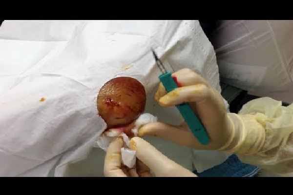 Elbow abscess drainage-12 Most Disgusting Videos Ever Made