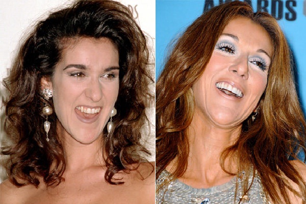 No Celine!-Celebrities Who Have Fixed Their Teeth