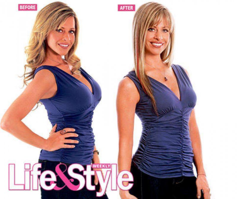 Dina Manzo Before and after Breast Reduction Surgery-15 Celebrities Who Had Breast Reduction Surgeries