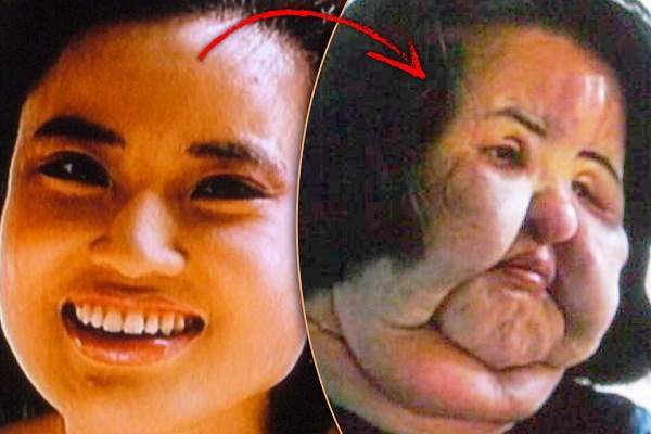 Beautiful Model Injects Cooking Oil Into her Face-DIY Medical Procedures Done By People On Themselves