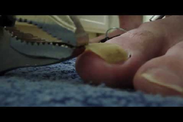 Toenail removed with pliers-12 Most Disgusting Videos Ever Made