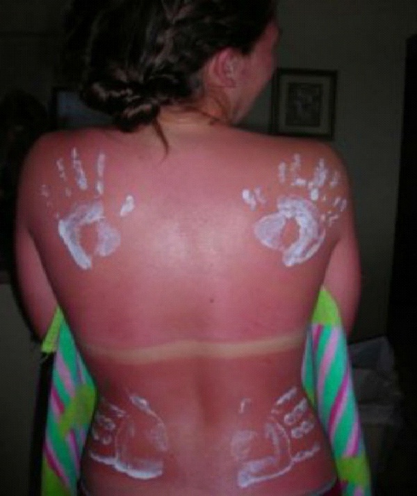 Where Have Your Hands Been?-Amazing Sunburn Art