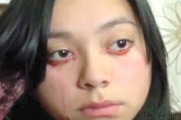 Woman Who Cries Blood-People With Amazing Medical Conditions