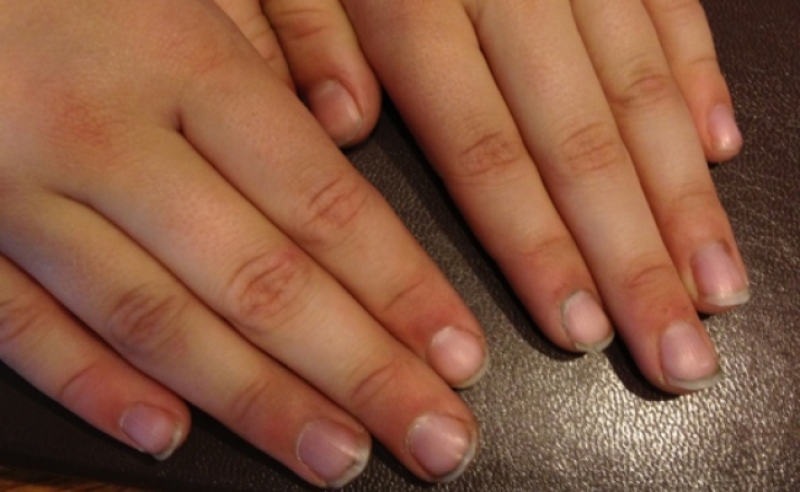 Germs Love Nails-Here's What Nail Biting Can Do To You