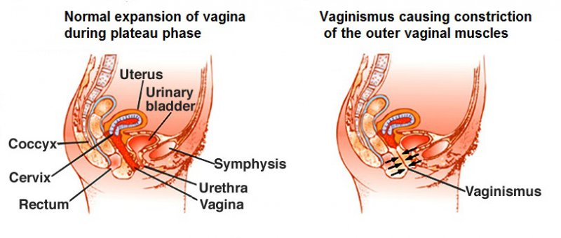 Very Tight Vagina-12 Signs Of An Unhealthy Vagina You Should Not Ignore