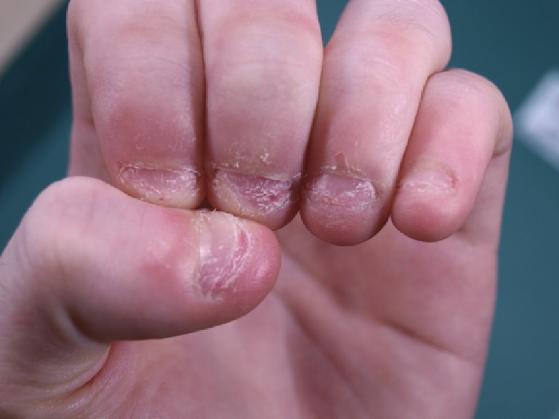 It Makes Your Fingertips Look Ugly-Here's What Nail Biting Can Do To You