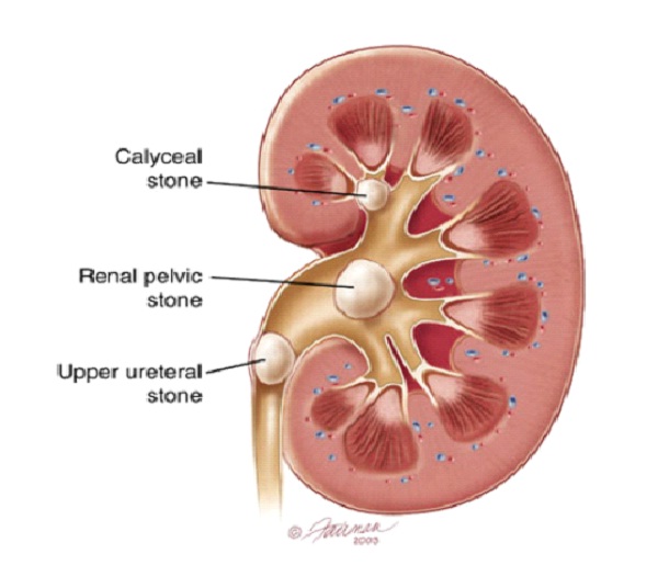 Kidney Stones-Most Painful Diseases In The World