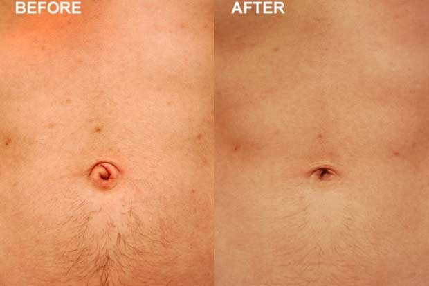 Belly button-Bizarre New Types Of Cosmetic Surgery