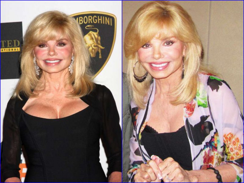 Loni Anderson Before And After Breast Reduction Surgery-15 Celebrities Who Had Breast Reduction Surgeries