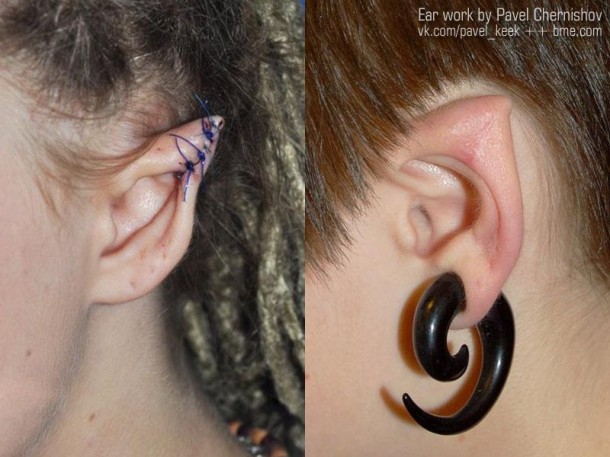 Elf Ears-Bizarre Body Modification Implants