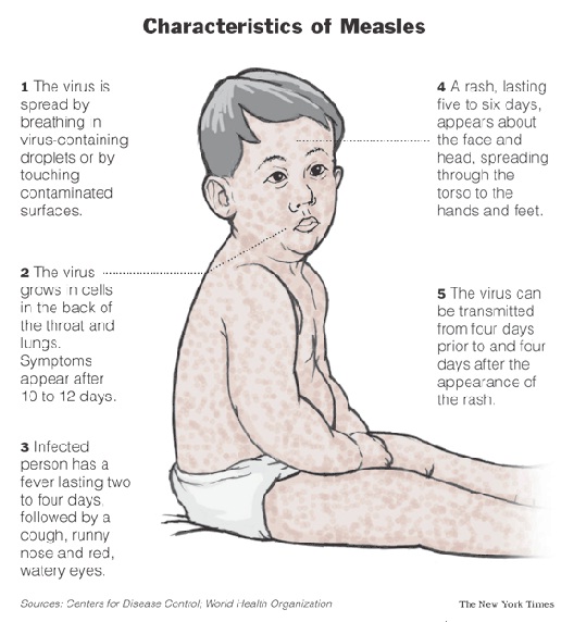 Measles-Most Dangerous Viruses In The World Today
