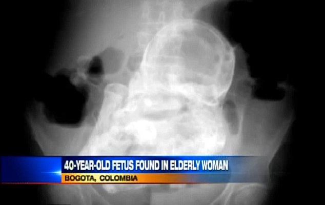 Calcified Baby-Most Shocking Things Found In Peoples Stomachs