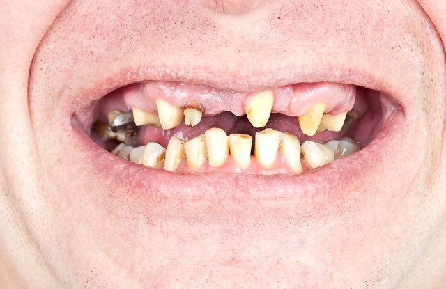 Woman Removes Teeth in Britain-DIY Medical Procedures Done By People On Themselves