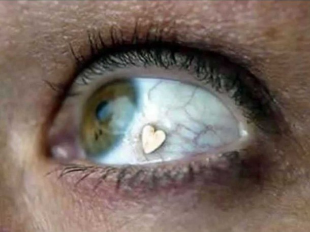 Extraocular Implant-Bizarre Body Modification Implants