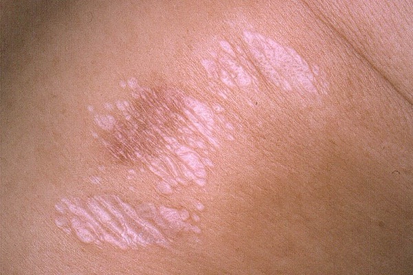 Unexplained marks-Signs That You Have Cancer