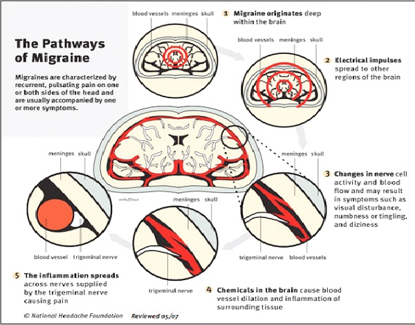 Migraines-Most Painful Diseases In The World