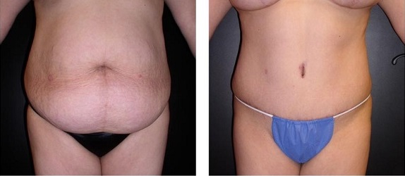 Tummy Tuck-Most Expensive Plastic Surgeries In The World