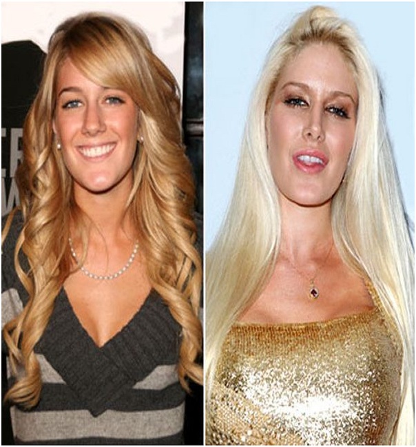 Heidi Montag (Before & After)-Top 18 Celebs With Plastic Surgery