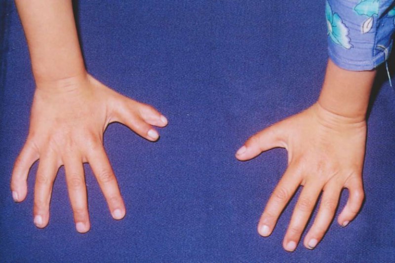 Extra Thumb-People Who Were Born With Extra Body Parts