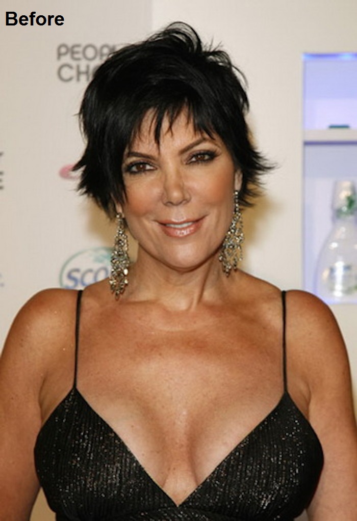 Kris Jenner Before and after Breast Reduction Surgery-15 Celebrities Who Had Breast Reduction Surgeries