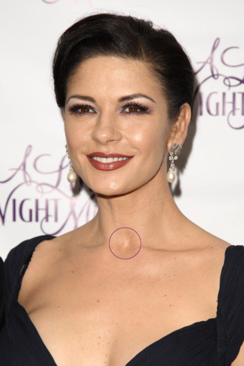 Catherine Zeta Jones - Neck Scar-12 Celebrities With Scars And Deformities