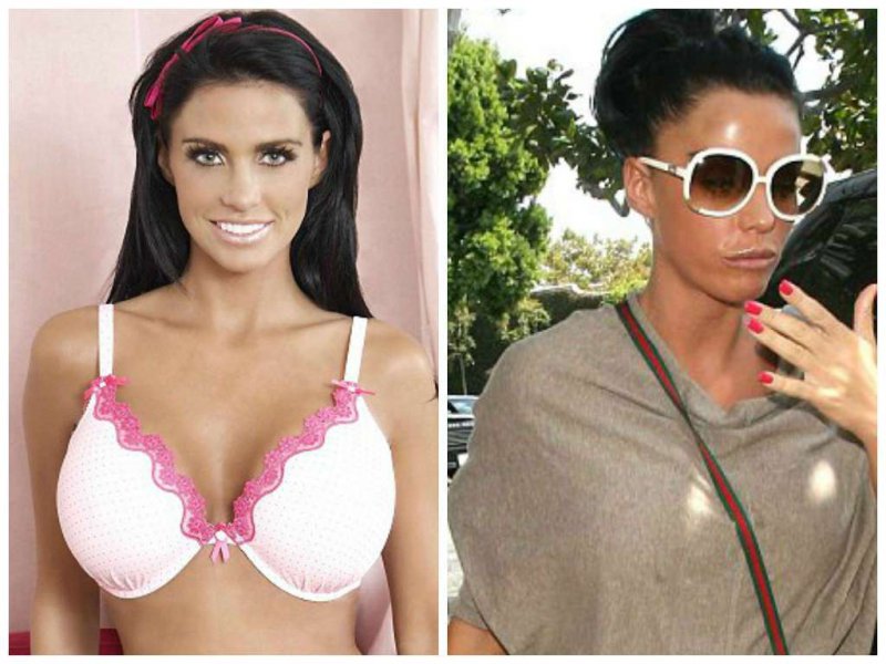 Katie Price Before and after Breast Reduction Surgery-15 Celebrities Who Had Breast Reduction Surgeries