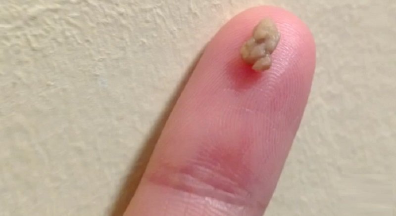 Stinky Tonsil Stones