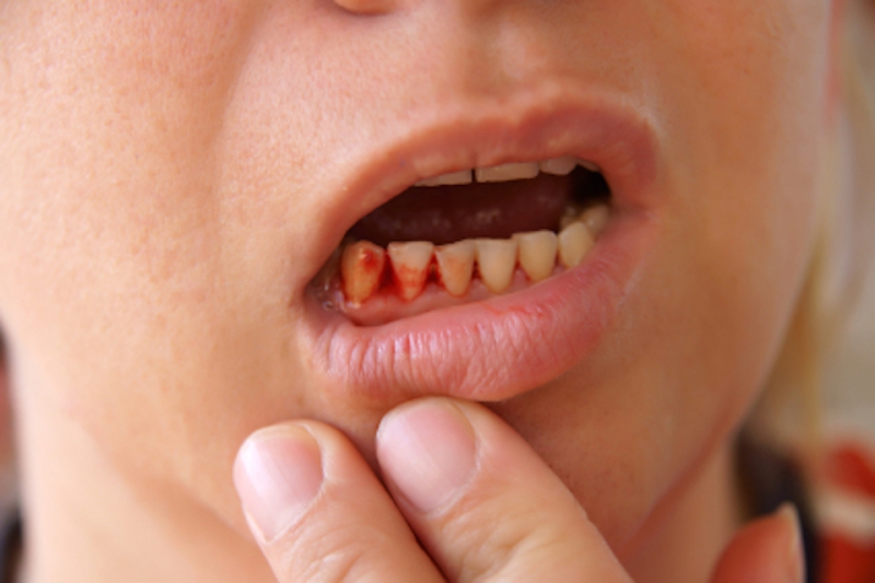 It Gives You Gingivitis-Here's What Nail Biting Can Do To You