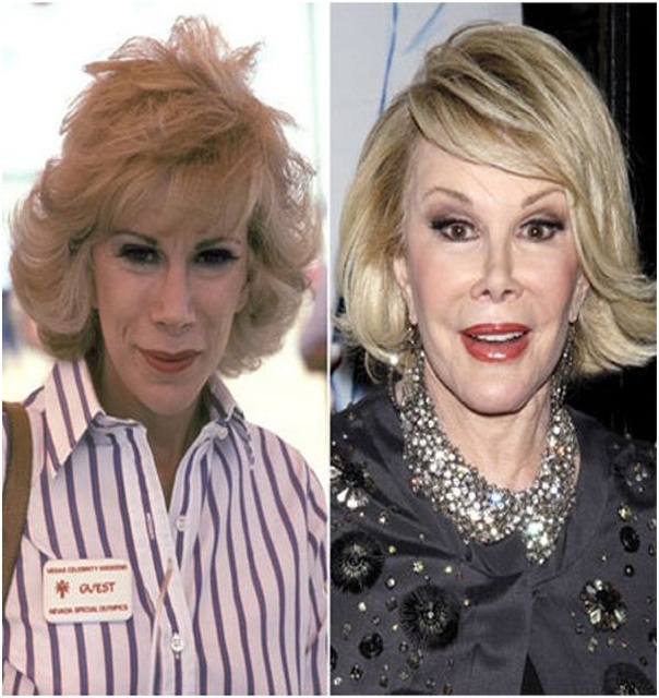 Joan Rivers (Before & After)-Top 18 Celebs With Plastic Surgery